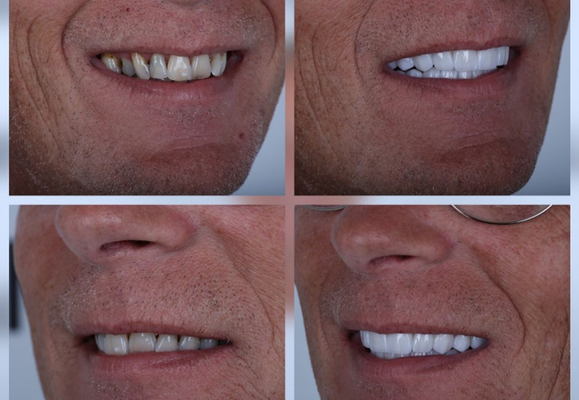 Alexander, zwak gebit en jaren gerookt