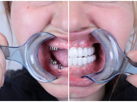 Tand Implantaten Turkije