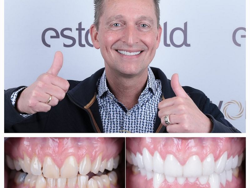 Hollywoodsmile-behandeling Turkije