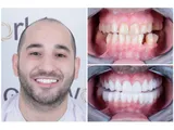 Tand Implantaten Turkije