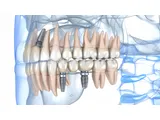 Tand Implantaten Turkije
