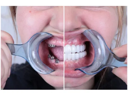 Tand Implantaten Turkije