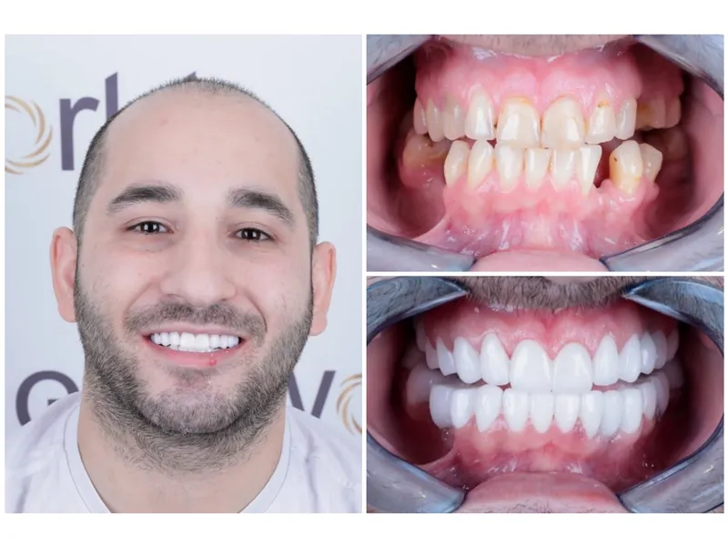 Tand Implantaten Turkije