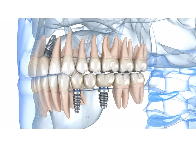 Tand Implantaten Turkije