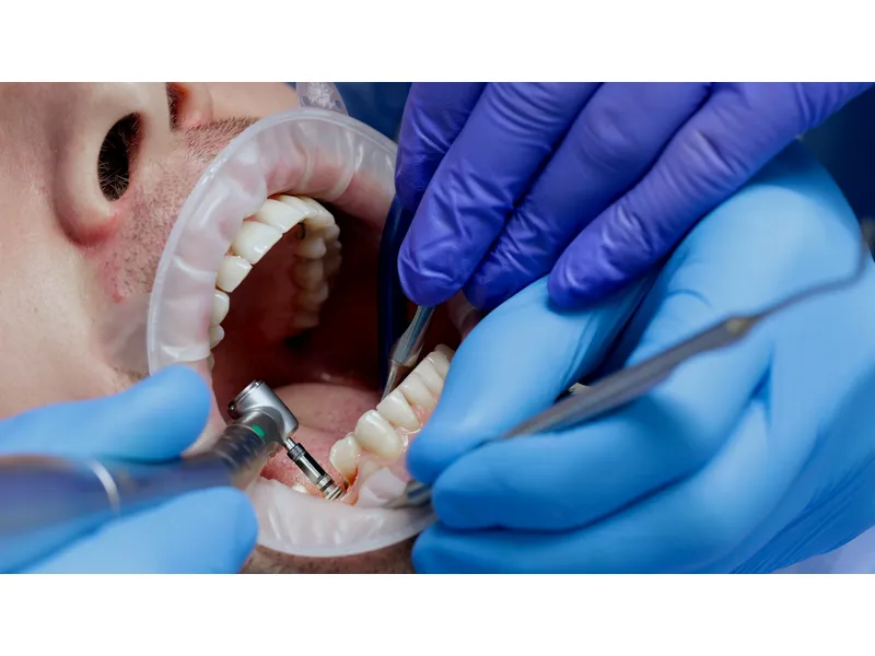 Tand Implantaten Turkije